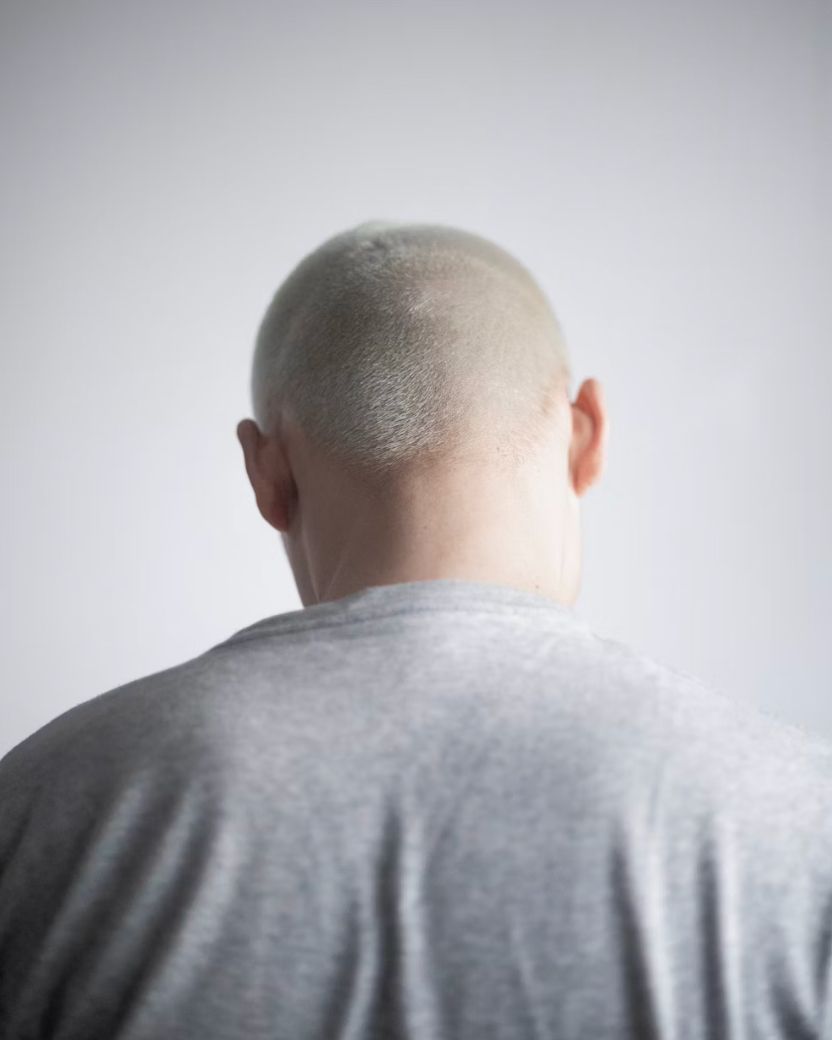 Red light therapy at home provides a non-invasive solution for slowing further hair loss.